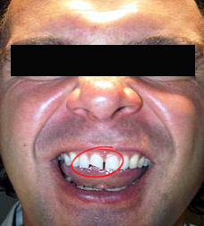 Broken-Pirate-Teeth